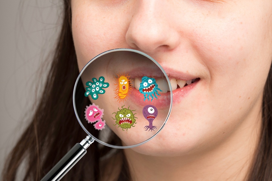 歯周病とは？段階別の症状や原因、歯肉炎や歯槽膿漏の違いを解説-4