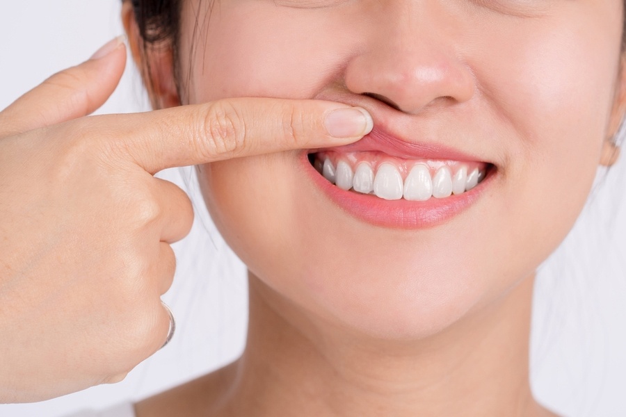 歯周病とは？段階別の症状や原因、歯肉炎や歯槽膿漏の違いを解説-3