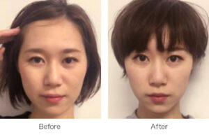 ほくろをキレイに除去したい！切縫法の効果と気になるリスクとは？-6